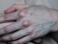 What the Veins on Your Hands Might Reveal About Your Liver Health